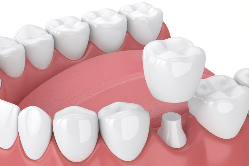 Dental Crowns in Kapolei