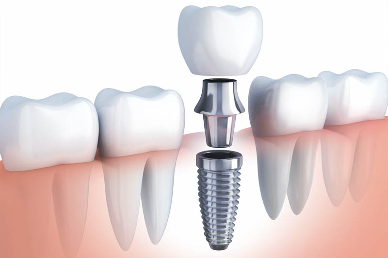 Implants Dentist in Kapolei