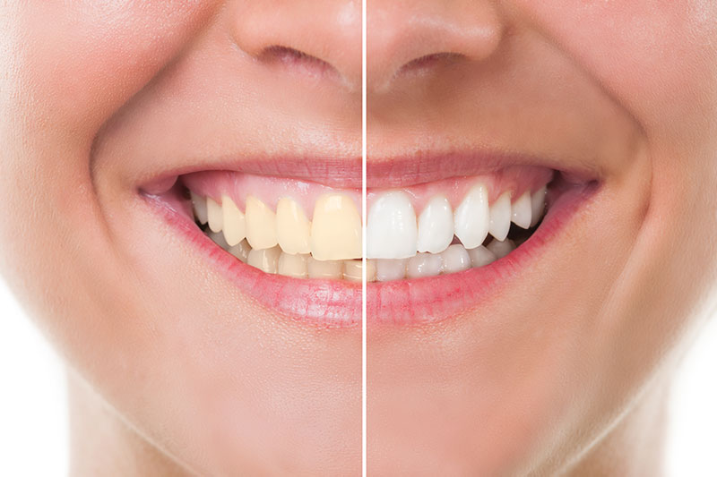 Teeth Whitening in Kapolei
